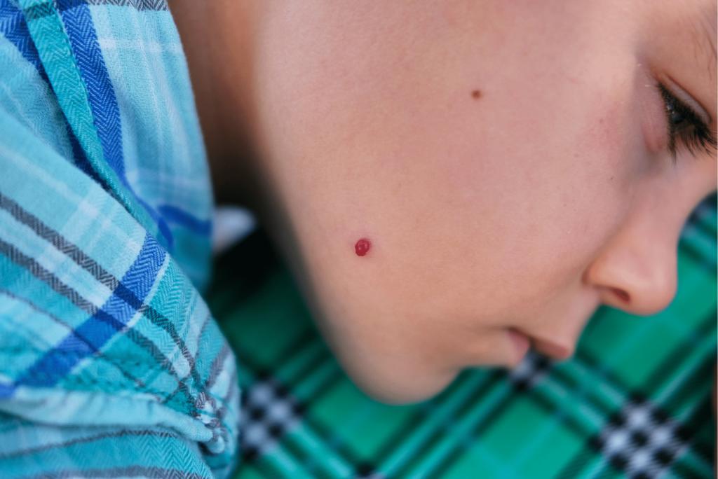 Poikiloderma o hemangioma