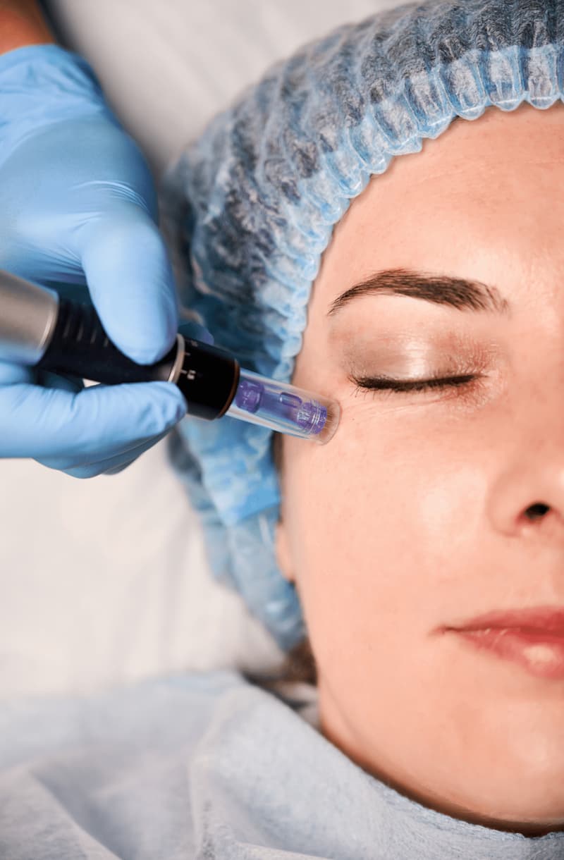 Mesoterapia facial